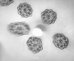 F,5y. | immotile cilia syndrome - trachea F,5y. | immotile cilia syndrome - trachea